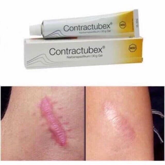 Kem Xử Lý Sẹo Contractubex Balan 20g