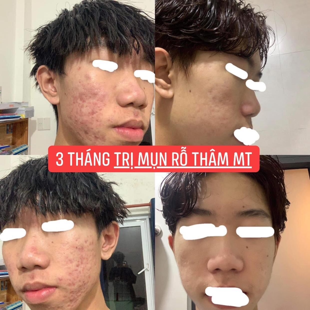 THẢO DƯỢC SẠCH MỤN MT (50ml)