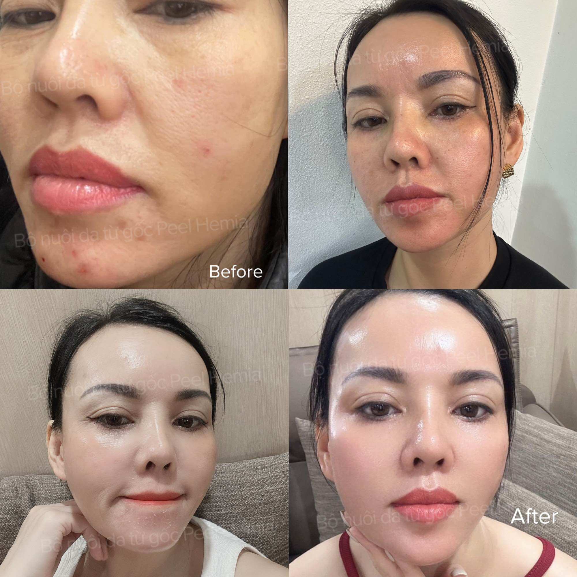 [Peel Da Hemia Hàn Quốc Căng bóng ]