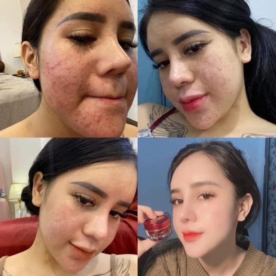Cao Mụn Sâm Đỏ 36 Vị - Cao Cấp - Hộp 5G