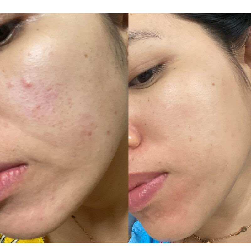 Kem mụn cao cấp E-ACNE (kem mụn organic)