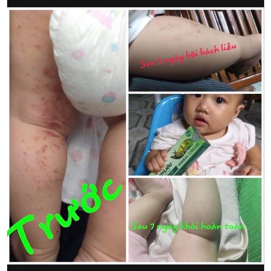 Kem bôi da thảo dược bách liễu
