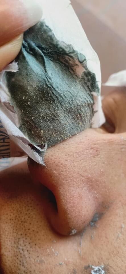 combo 2gel lột mụn dr. acne