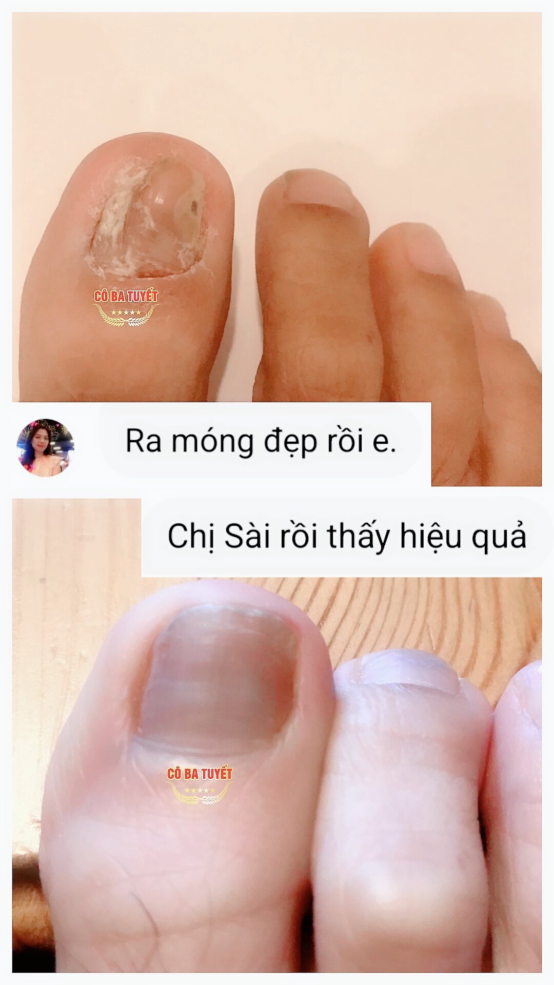Nấm móng tay chân