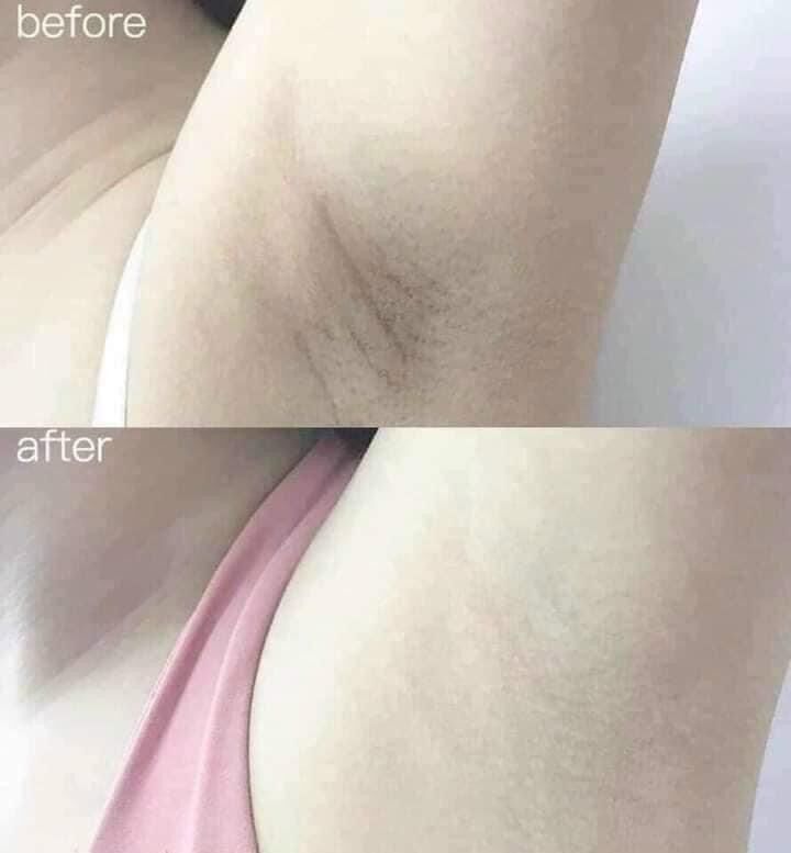KEM THÂM NÁCH, THÂM MÔNG, BIKINI Q-NIC CARE THÁI LAN