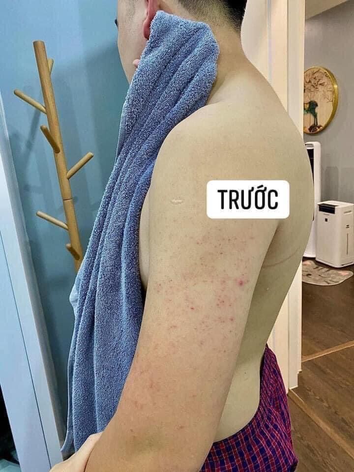 kela viêm nang lông 60ml thái lan