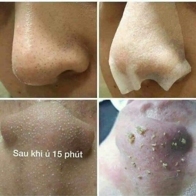 (30/50ml-CHIẾT CHAI NHỎ+QUÀ TẶNG) Dung Dịch Ủ Đẩy Mụn Đầu Đen MEDIPEEL EXTRA SUPER 9 COMPLEX
