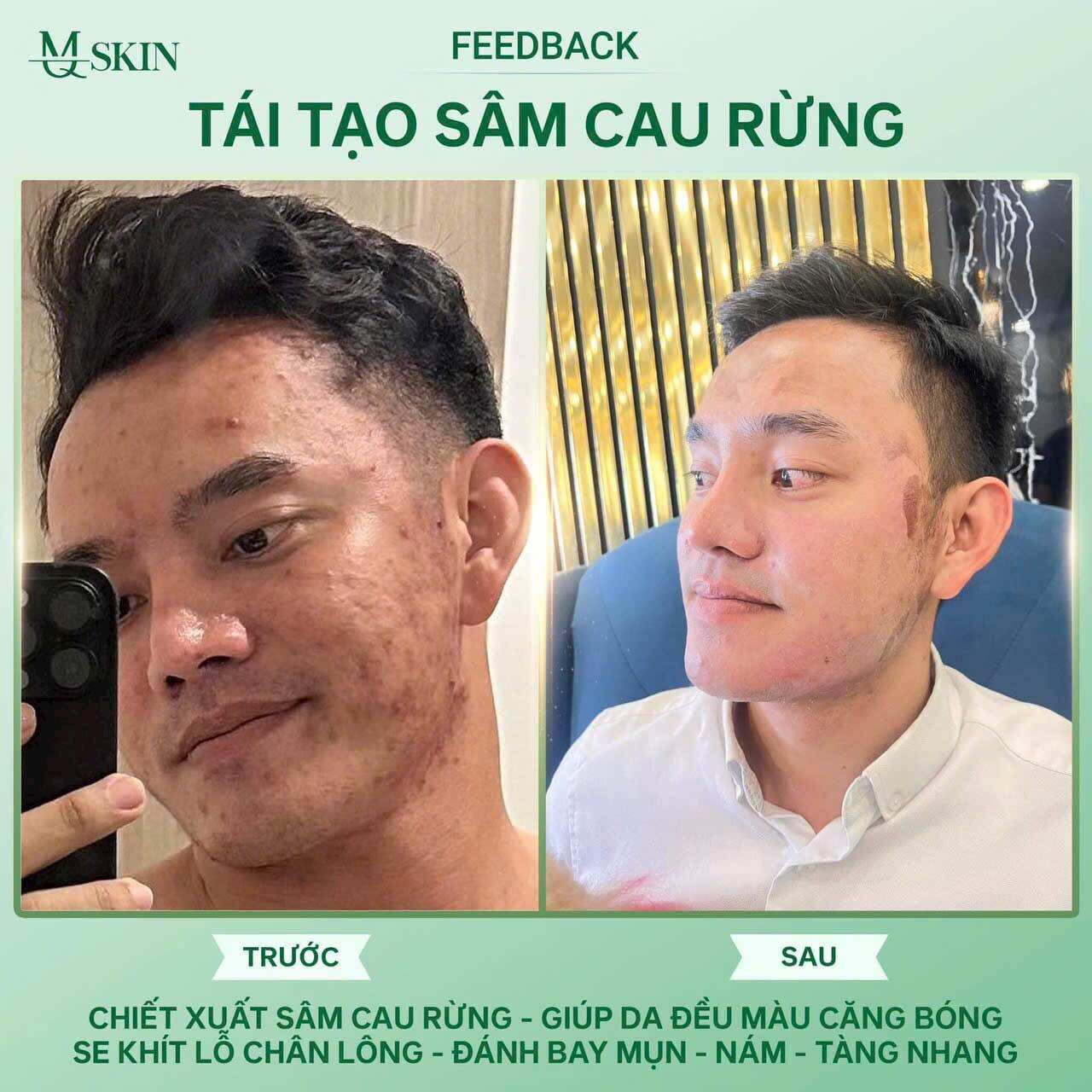 Combo Tái tạo sâm cau rừng( liệu trình 3 món)