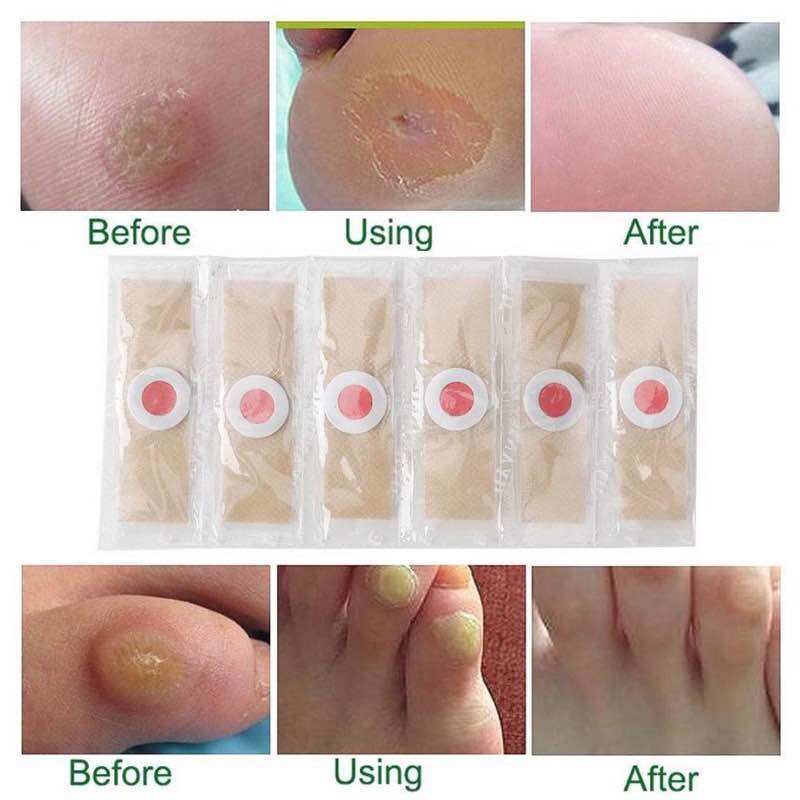 Set 15 Miếng dán mụn cóc hiệu quả nhanh dễ sử dụng