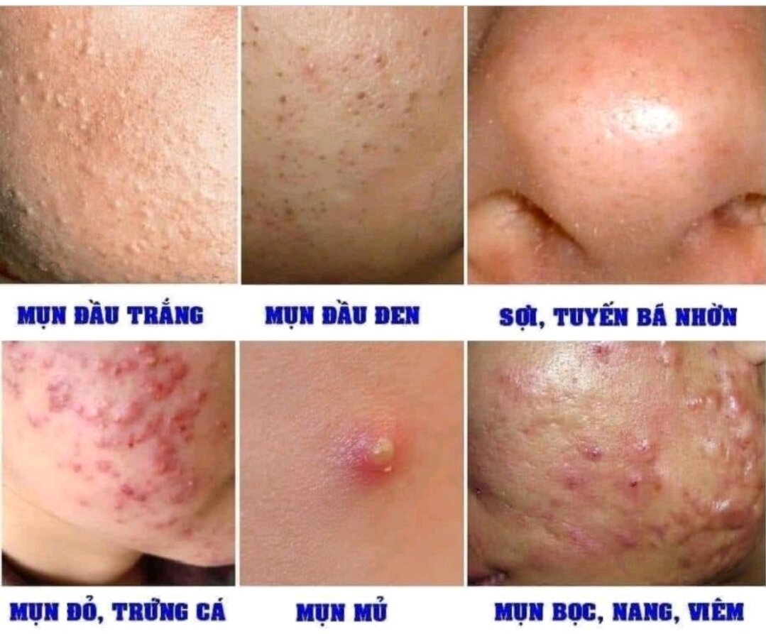 Tinh chất giảm mụn Ac Bac Serum Hàn Quốc 30ml