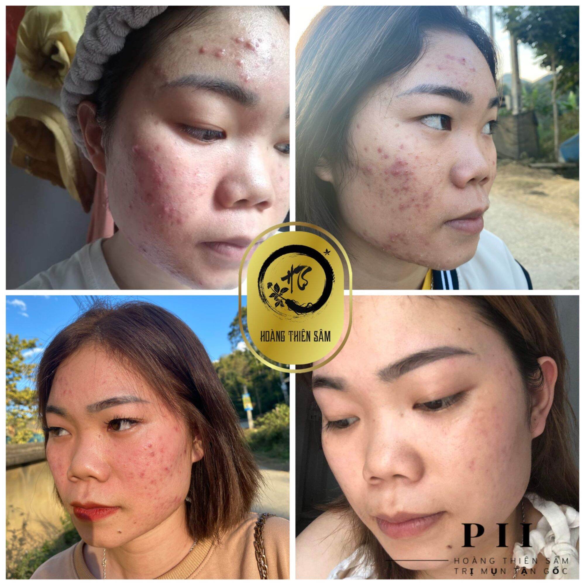 combo2 tinh chất Hoàng Thiên Sâm