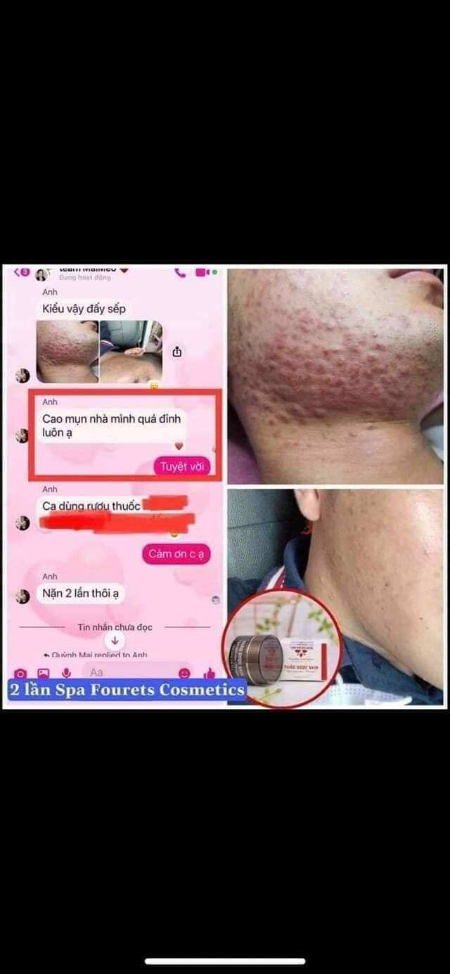 Thảo dược skin (cao mụn)