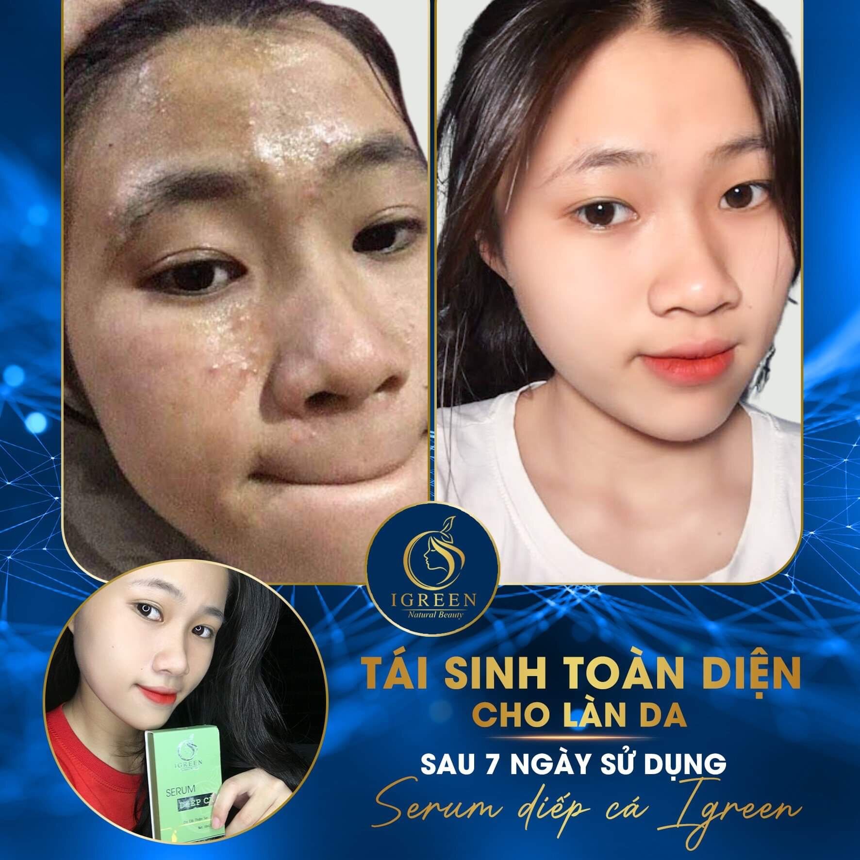 COMBO TOÀN DIỆN IGREEN-SẠCH MỤN,THÂM( serum diếp cá+sữa rửa mặt diếp cá)