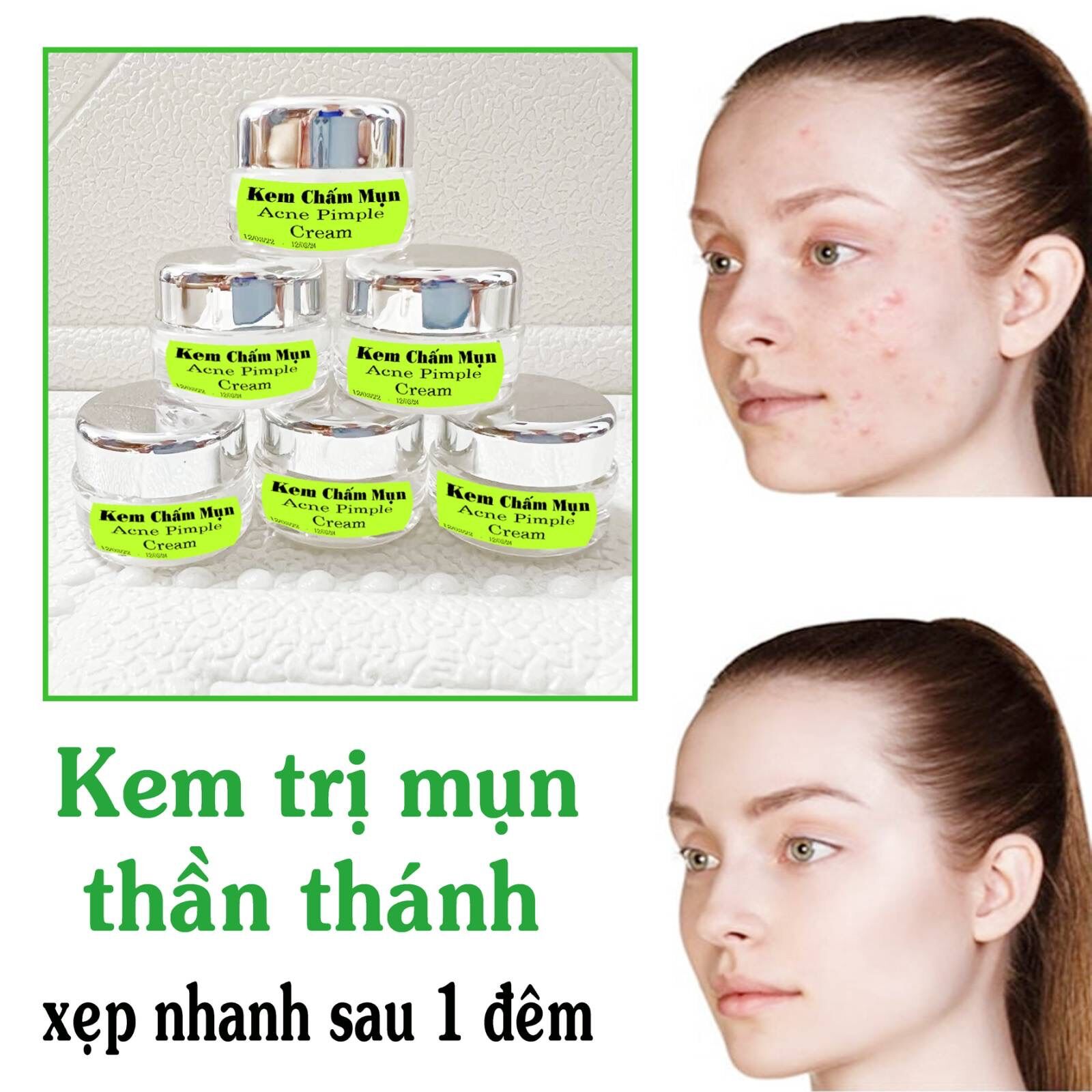 Kem Chấm Mụn Xẹp Nhanh Mụn Bọc,Mụn Viêm