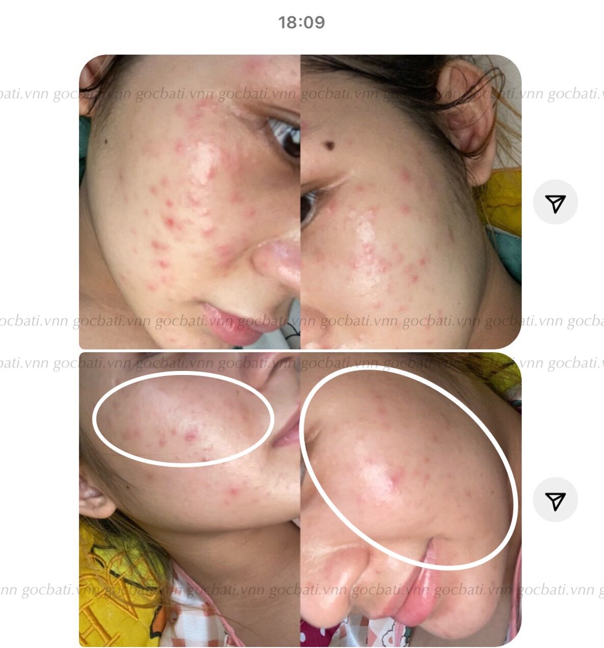 ANTI ACNE SERUM GBT