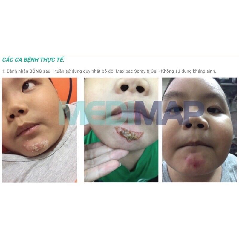 Gel kháng_khuẩn phục hồi da Maxibac
