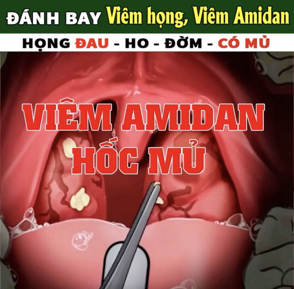 Hết ngay amidan hốc mủ nếu bạn siêng súc họng với Tinh Dầu này mỗi ngày