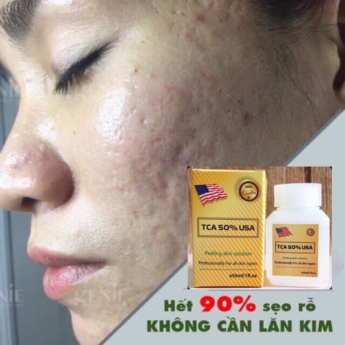 (Hàng Mỹ) Peel Da Tca Đánh Bay Mụn Rỗ Thâm Nám Lỗ Chân Lông To Da Dầu Rạn Sẹo Lồi Làm Trắng Mịn Da