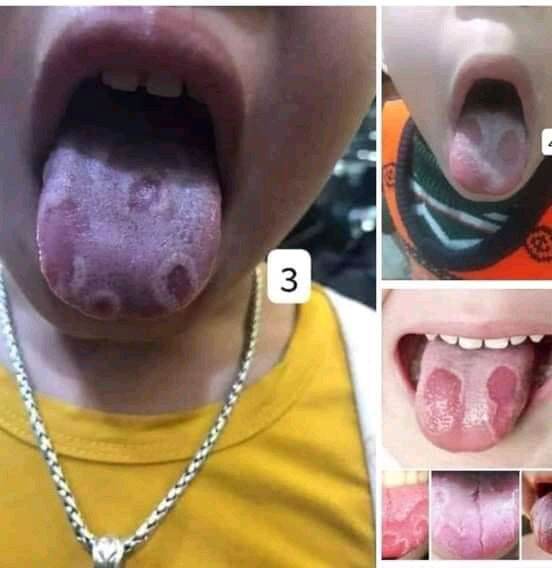 Sâu răng nhật Dương_ sâu sún răng Nấm lưỡi
