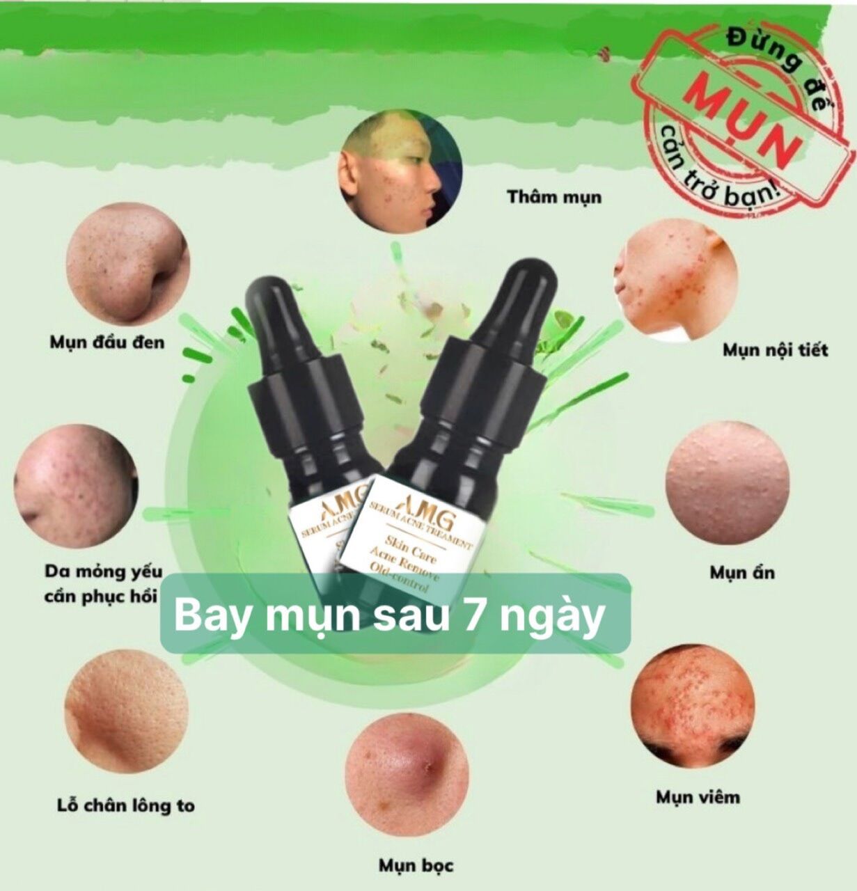 Serum mụn siêu tốc AGM 5ml