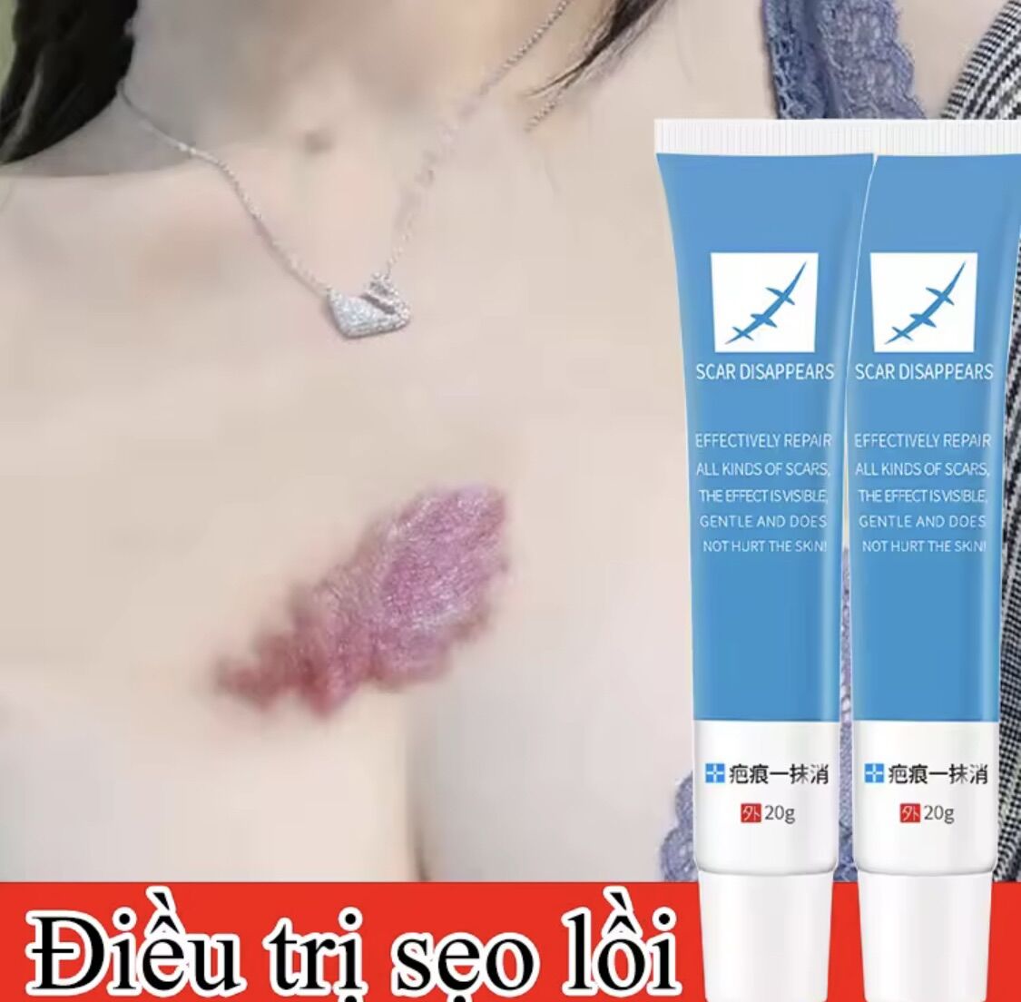 Kem xóa seo nhanh,vêt seo trây, vêt böng, phâu thuât, , läm mò seo