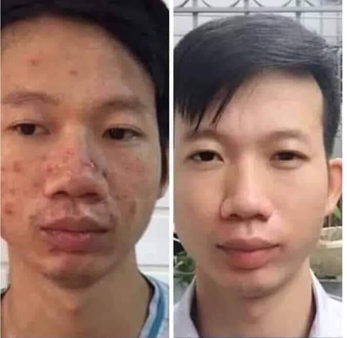 Mụn- Trần Kim Huyền( Lương y Lý Thị Bích Phượng)