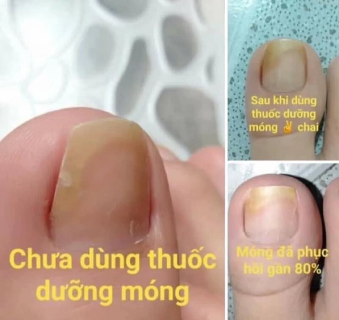 2 chai đánh bay nấm móng SH CHÍNH HÃNG