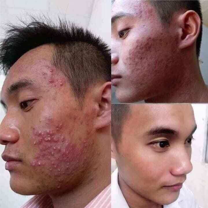 COMBO TOÀN DIỆN CHO DA HẾT MỤN, THÂM - COMBO DIẾP CÁ IGREEN