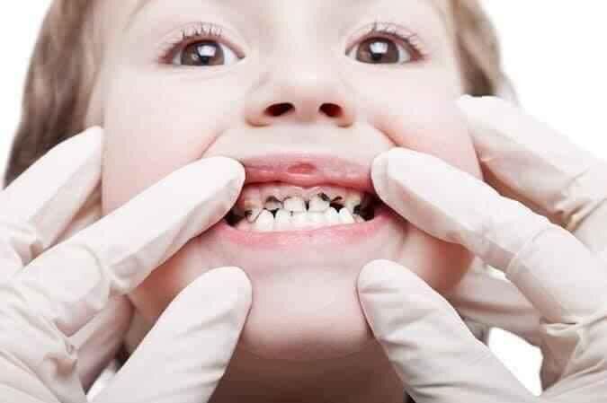 xịt chống sâu răng cho bé