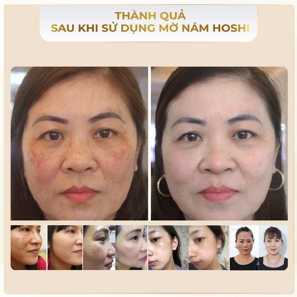 [MUA 2 TẶNG 2] Bộ mờ nám, trắng da Hoshi Nhật Bản ( Tặng 1 Sủi và 1 KCN Hoshi)