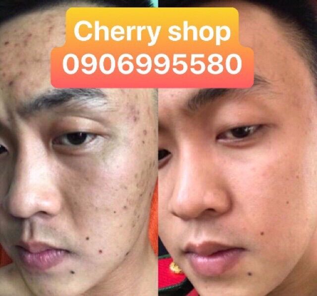 Serum chấm mụn Linh Chi Vàng 25ml