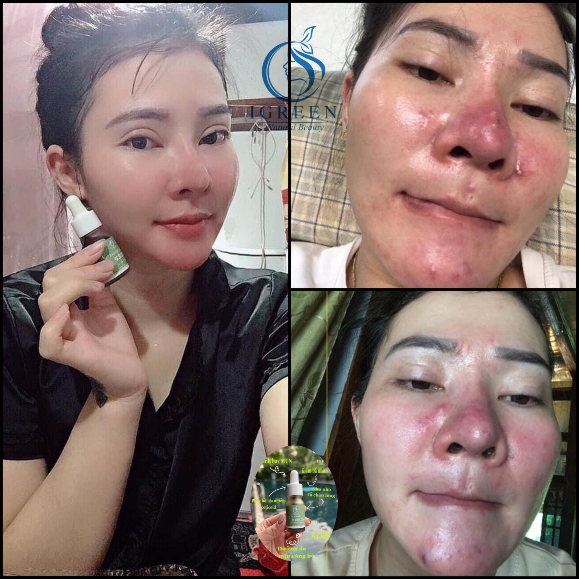 COMBO TOÀN DIỆN CHO DA HẾT MỤN, THÂM - COMBO DIẾP CÁ IGREEN