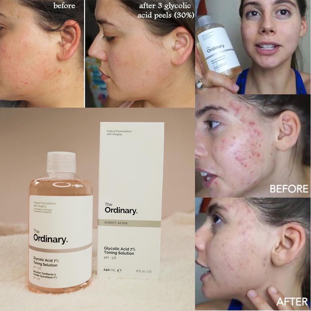 Toner Tẩy Da Chết Glycolic Acid 7% Toning Solution The Ordinary