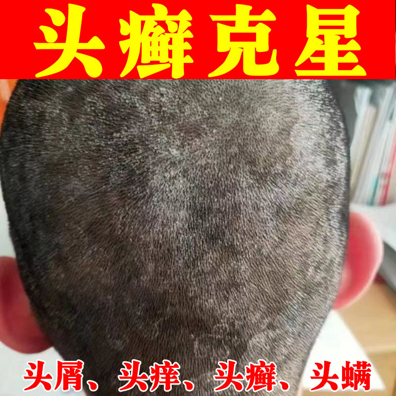 Thuốc Bôi Cho Nấm Đầu Trị Ngứa Đầu Đầu Vảy Nến Bạc Tiết Nấm Đầu Trừ Ve