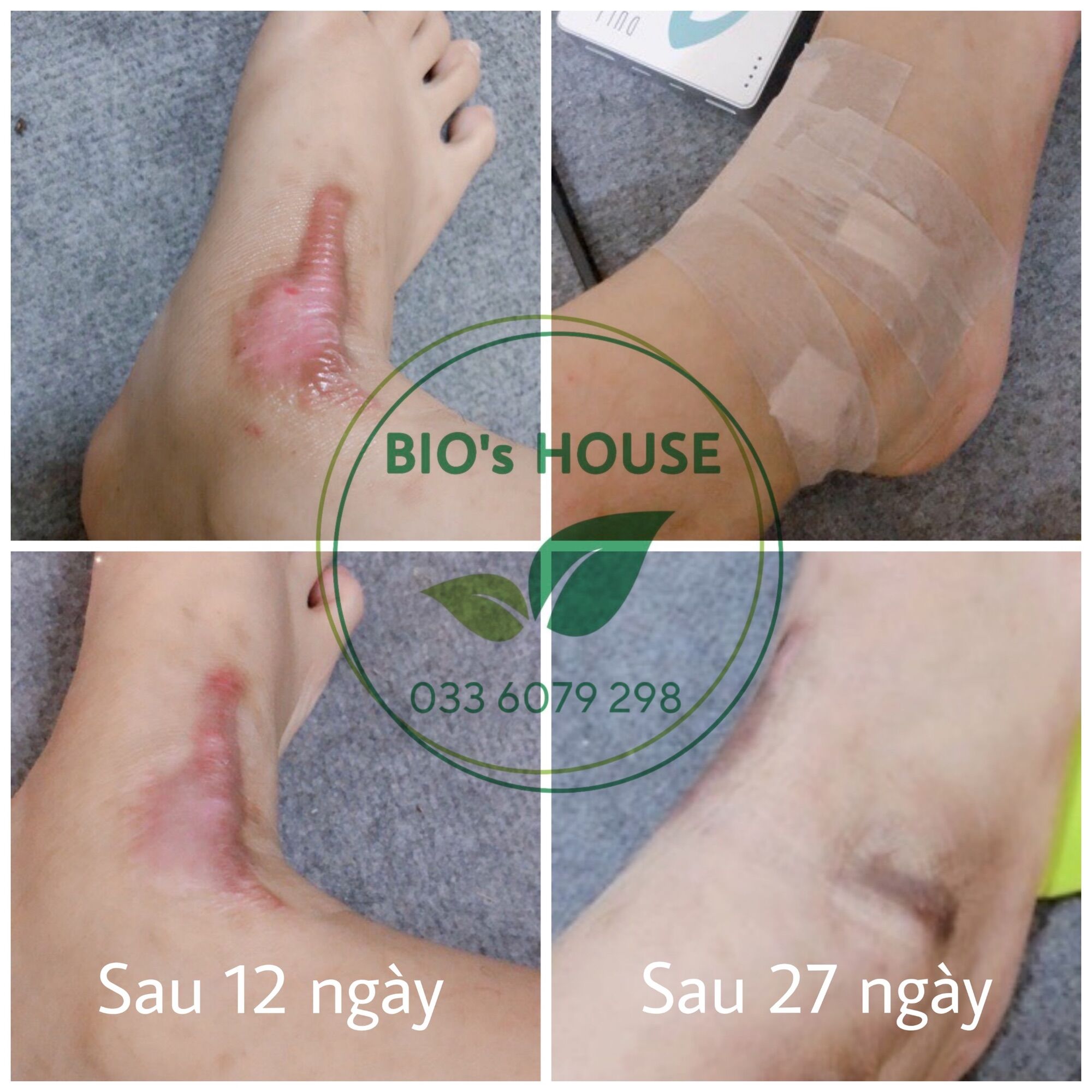 Miếng dán ép sẹo lồi ECLAR PLASTER (HISAMITSU) Nhật Bản - (Date mới)