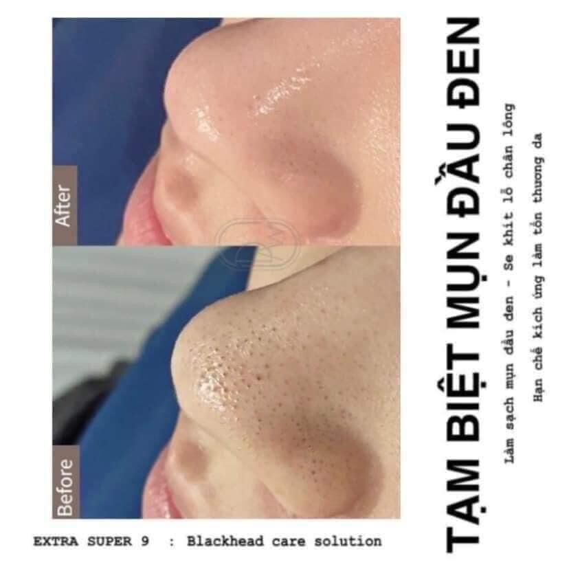 (30/50ml-CHIẾT CHAI NHỎ+QUÀ TẶNG) Dung Dịch Ủ Đẩy Mụn Đầu Đen MEDIPEEL EXTRA SUPER 9 COMPLEX