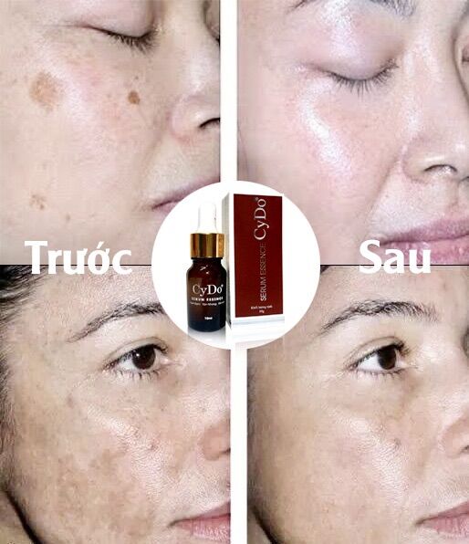 [HCM]SERUM CYDO ESSENCE NÁM SẠM TÀN NHANG 10ML