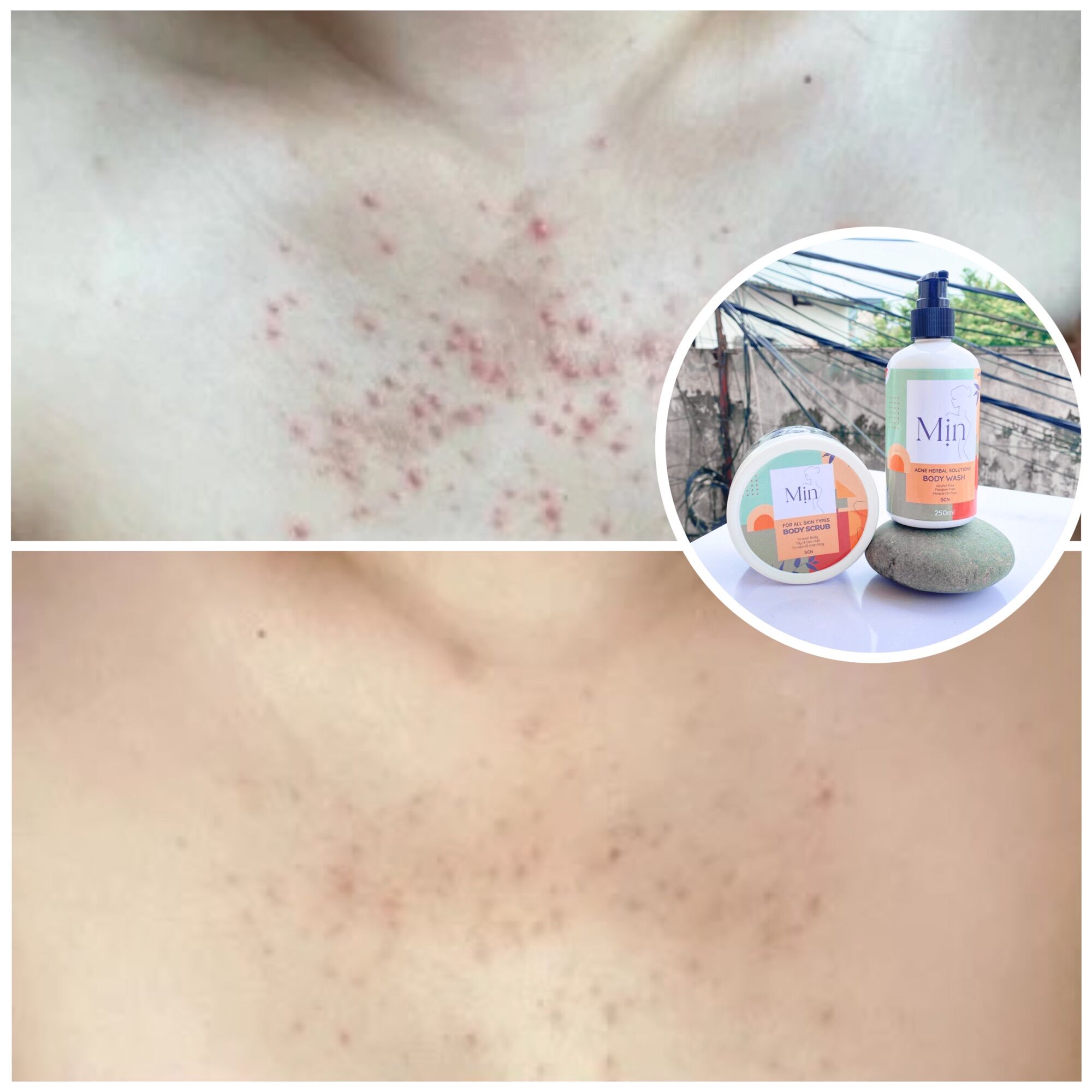 Hũ Muối Dẻo Scrub Mịn - Mụn, Viêm Nang, TTBC
