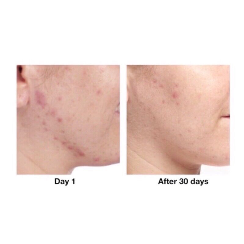 [Bill Canada] Gel chấm mụn Acne Solutions Clearing 15ml (tách set no box)
