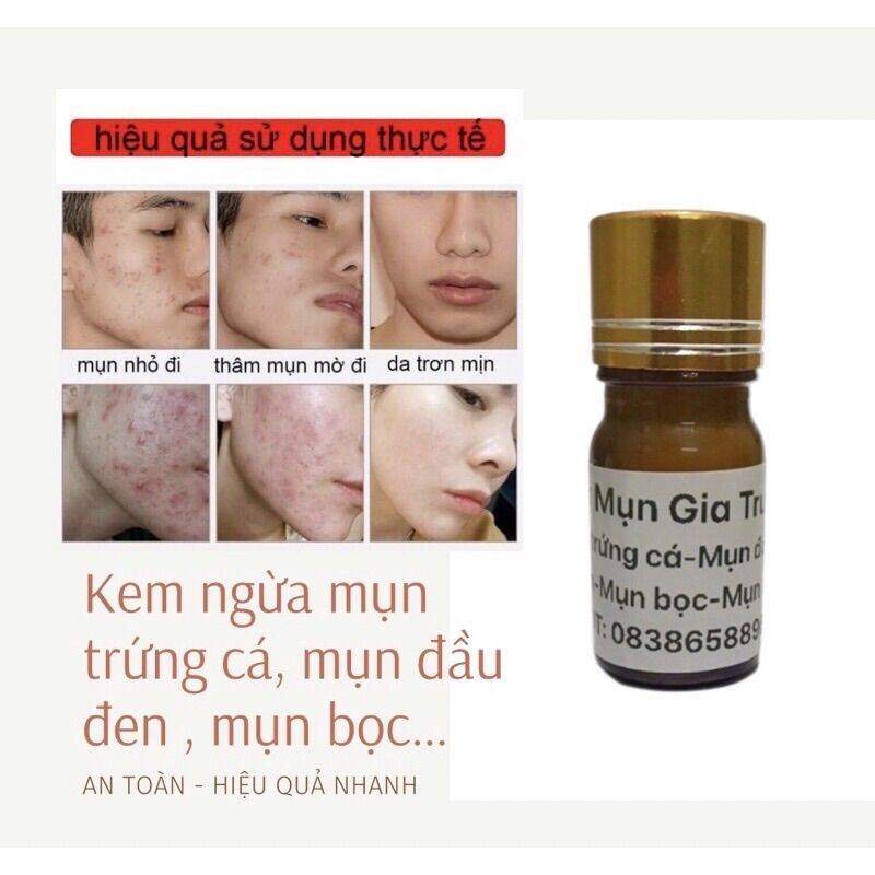 Kem ngừa mụn hiệu quả nhanh