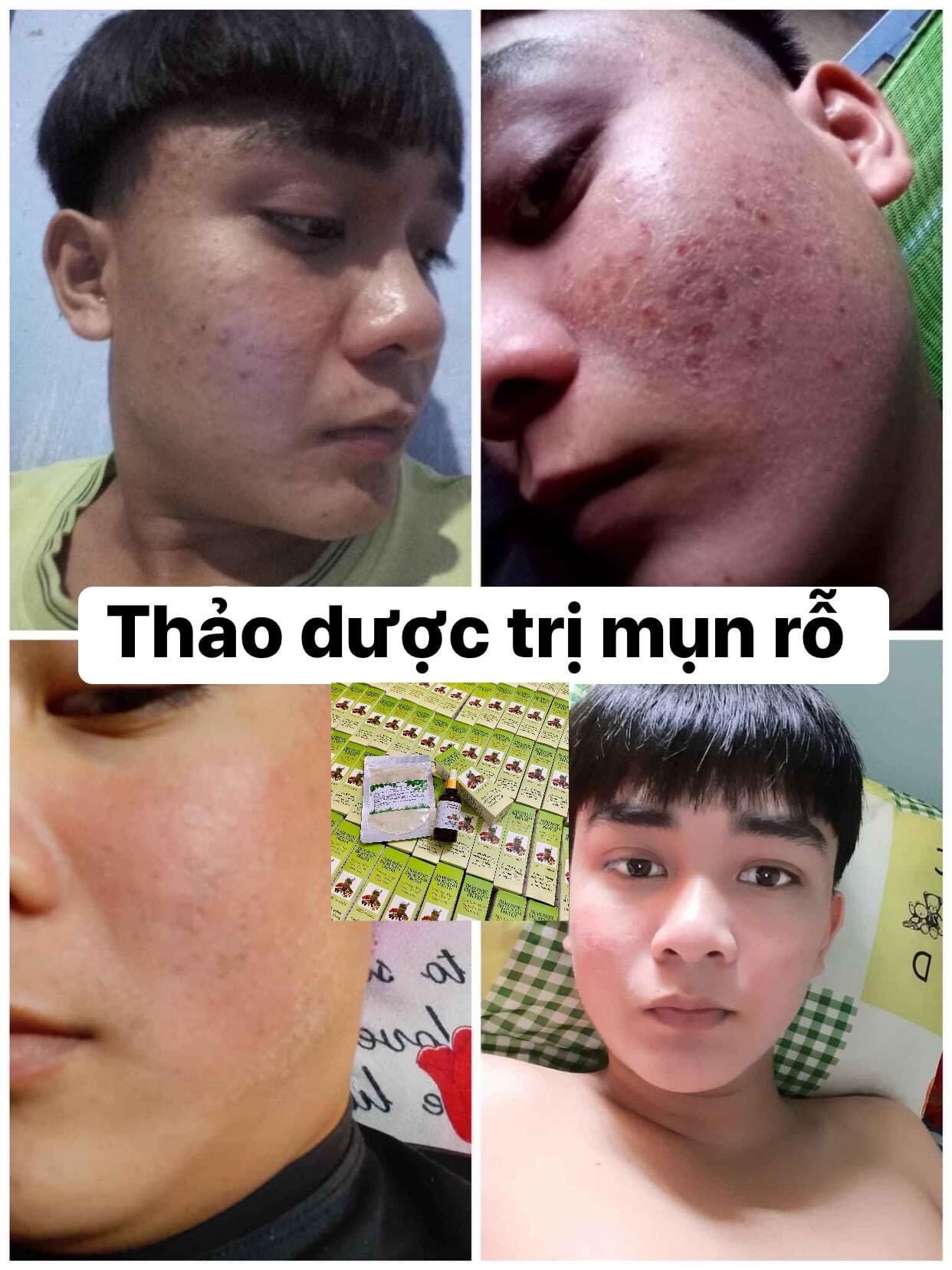 Compo 2 Lọ Thảo Dược Sạch Mụn MT (50ml)
