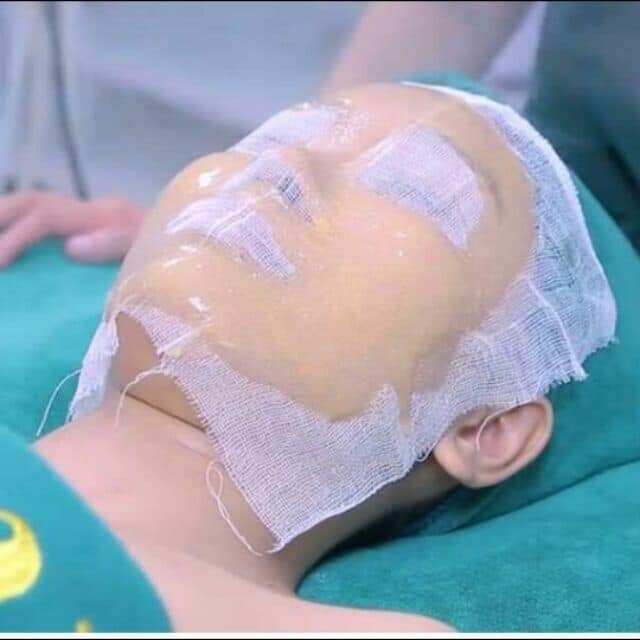 Gạc đắp mặt