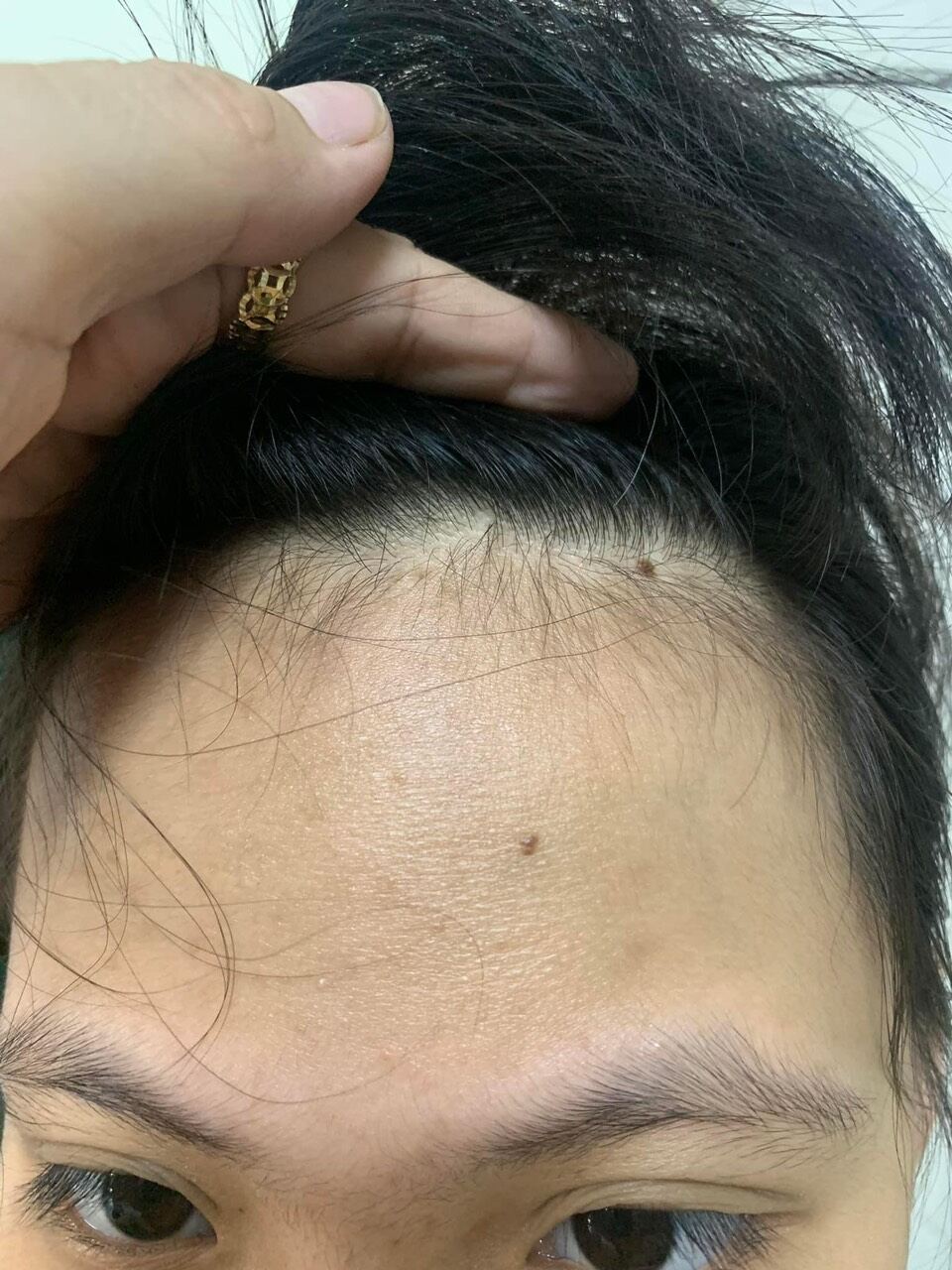 SERUM MINKUN SKIN Sạch mụn
