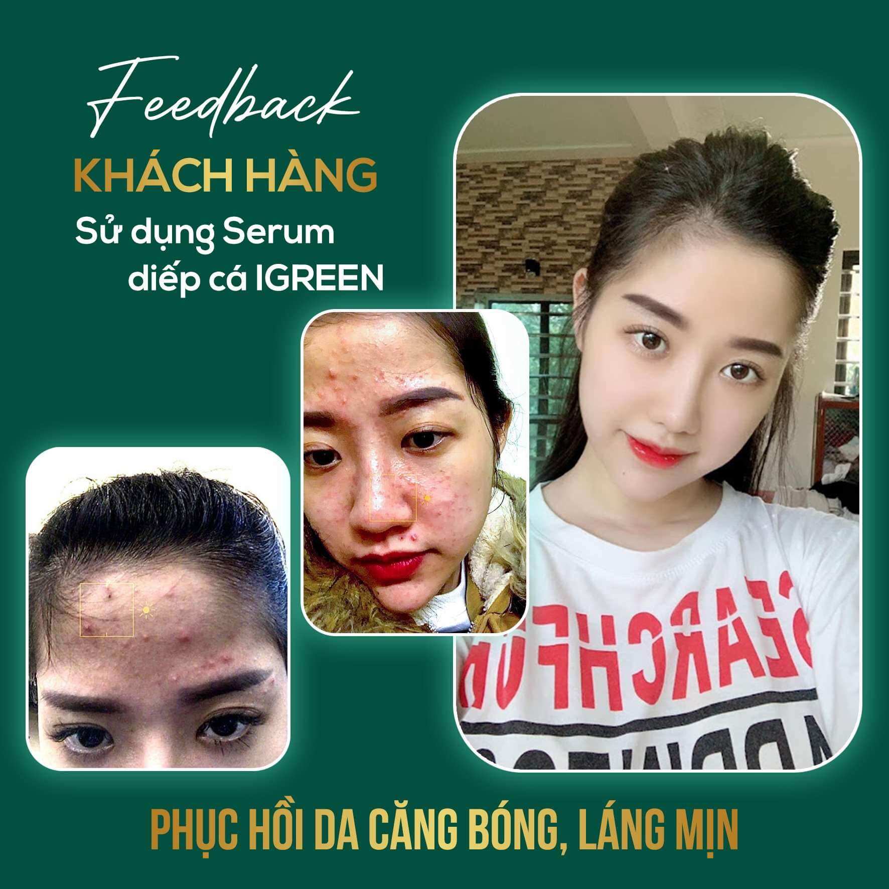 Combo Diếp Cá IGREEN (Sữa rửa mặt + Serum) – Sạch mụn, thâm