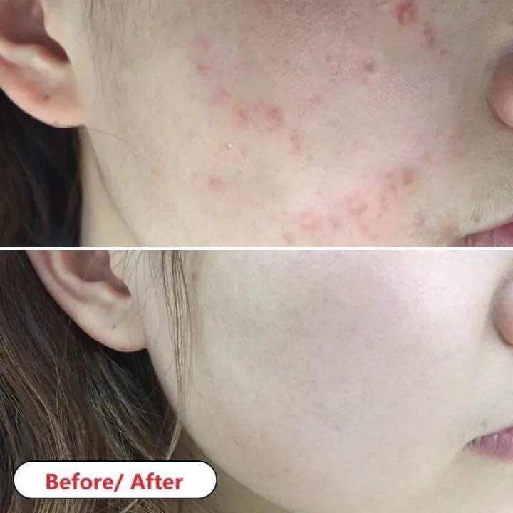 Gel Klen-Ms giảm mụn thâm mụn ẩn mụn trứng cá