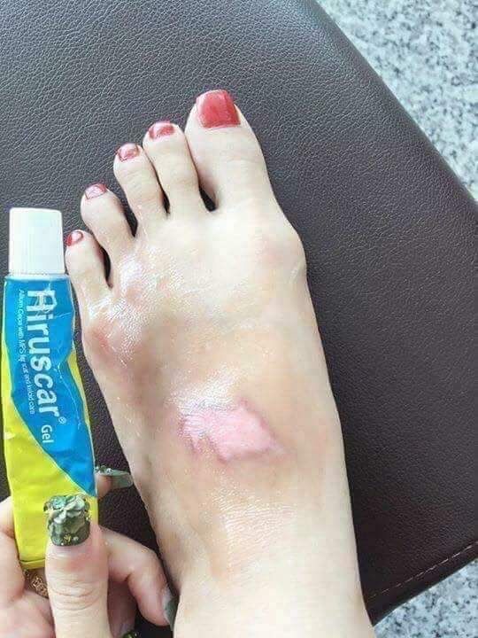Kem bôi sẹo hiruscar thái lan