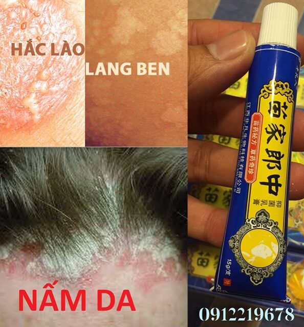 Nấm, Hắc Lào, Lang Ben, vẩy nến á sừng, viêm da cơ địa Hiệu quả sau vài lần sử dụng