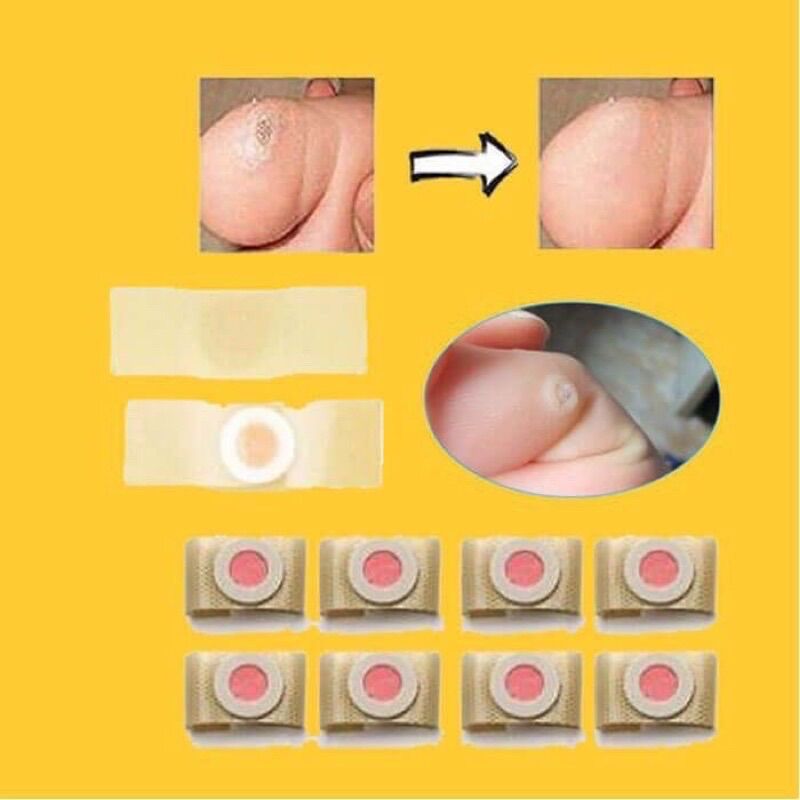 Miếng dán Plastet mụn cóc, mụn cơm, mắt cá chân