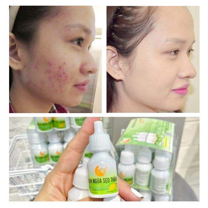 kem chấm mụn siêu tốc k3