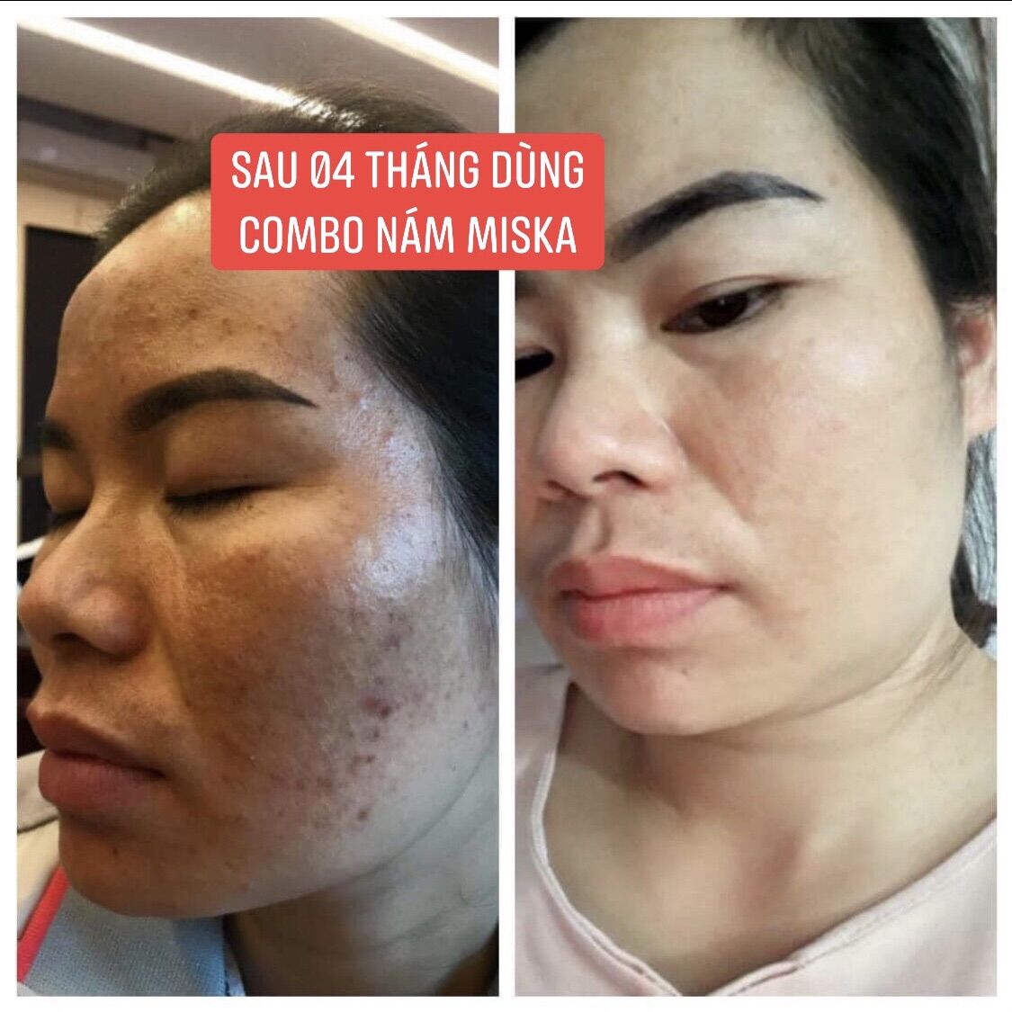 Combo Dưỡng Trắng Da Trị Thâm Nám Miska Skin
